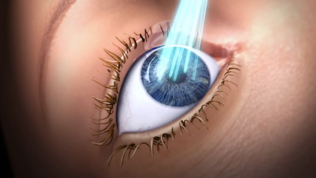 Cirurgia Refrativa